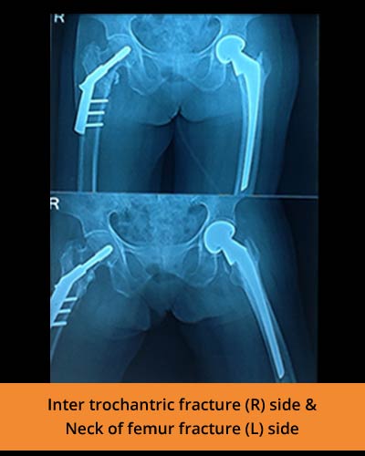 Inter-trochantric-fracture-bipolar-hemi-ortho plasty-(Ortho-hospital).JPG